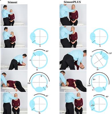 Frontiers | BPPV: Comparison of the SémontPLUS With the Sémont